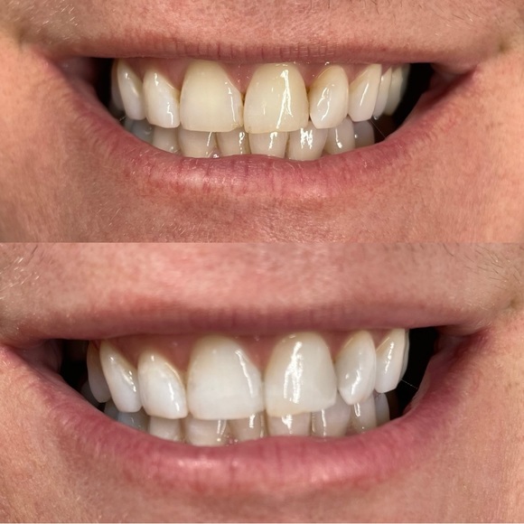 TEETH WHITENING KIT - Picture 3 of 4